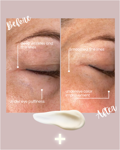 Before and after comparison of eye area treatment showing reduced wrinkles, lines, puffiness, and improved undereye color.