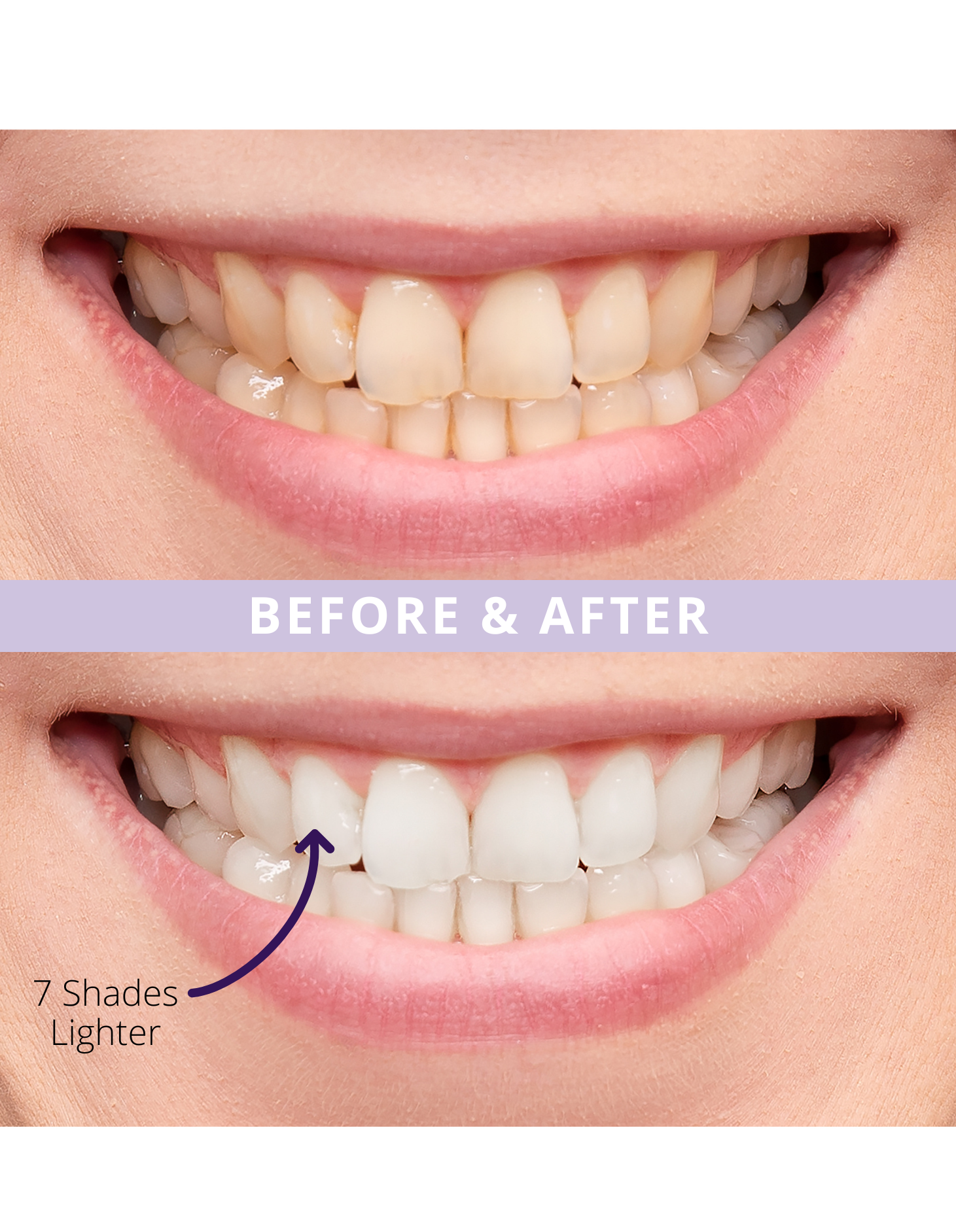 Magic Melt-Away Teeth Whitening by ELIMS. Clinically proven to lighten teeth upto 7 shades in 14 days. Totally enamel safe! Made for sensitive teeth. Before and after!